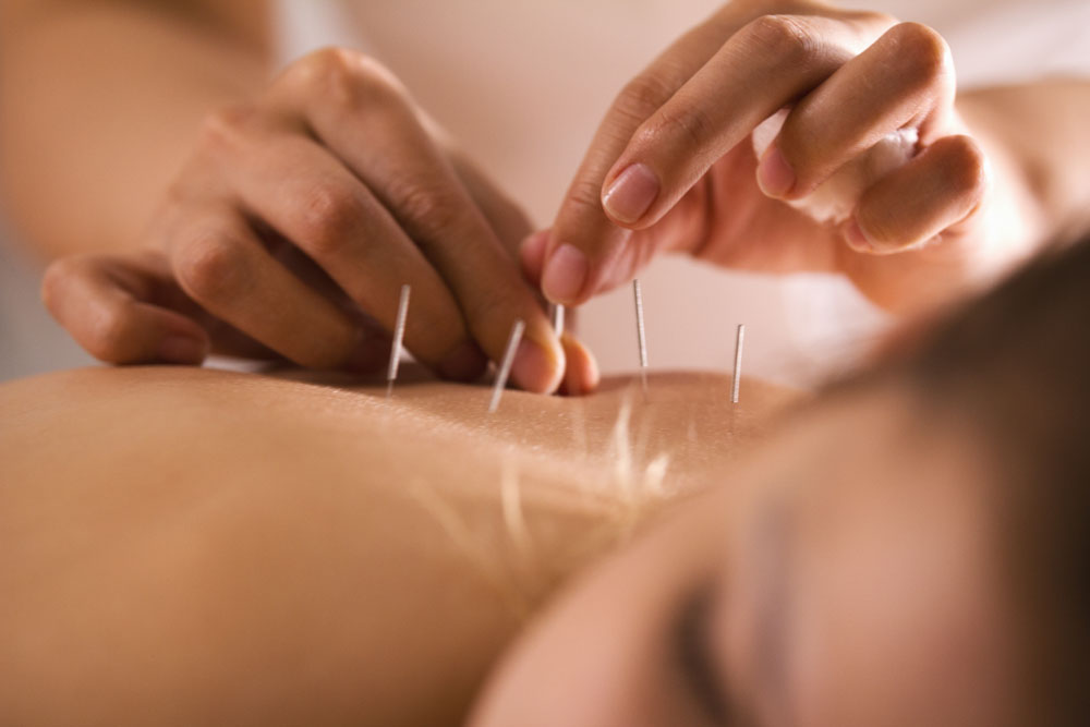 Agopuntura medicina alternativa